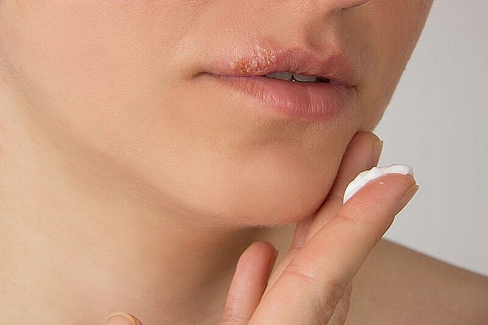 Как избавиться от простуды на губах?